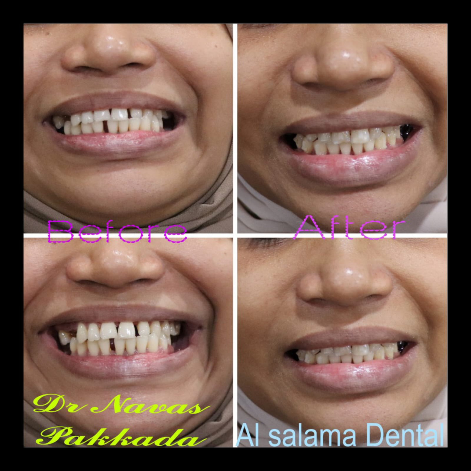 Dental Aligners